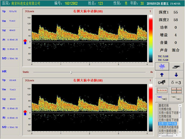 經(jīng)顱多普勒單通道，雙深度界面
