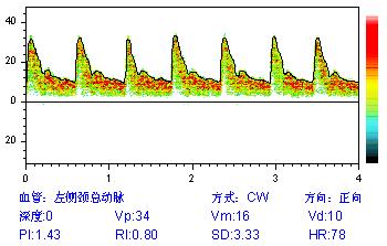 經(jīng)顱多普勒?qǐng)?bào)告中間頻譜圖含義.jpg