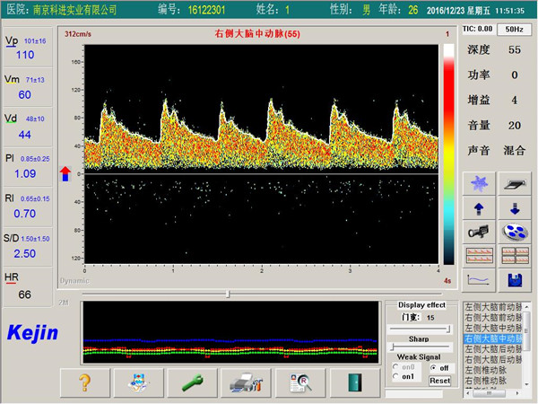 超聲經(jīng)顱多普勒血流分析儀檢測界面.jpg