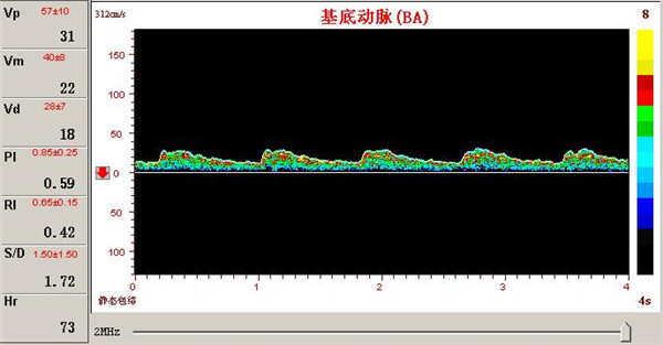 經(jīng)顱多普勒檢測(cè)椎基底動(dòng)脈供血障礙的表現(xiàn)