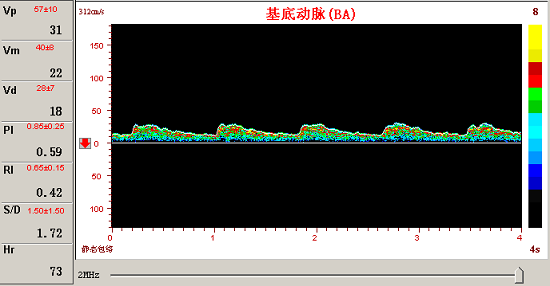 經(jīng)顱多普勒對(duì)椎─基底動(dòng)脈的