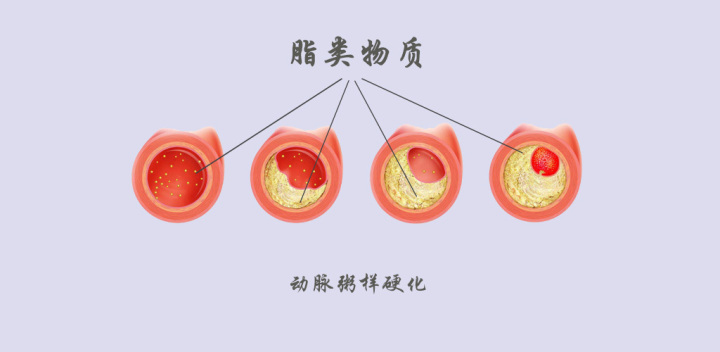 顱內動脈粥樣硬化與缺血性腦卒中的關系