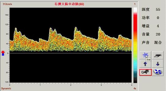 正常腦血管多普勒頻譜及各血流參數(shù)